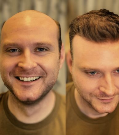 Kunde vorher und nachher mit dem Thin Skin 0.06